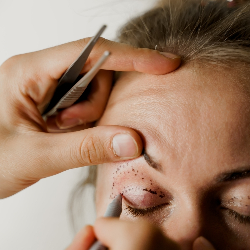 Resultado Blefaroplastia